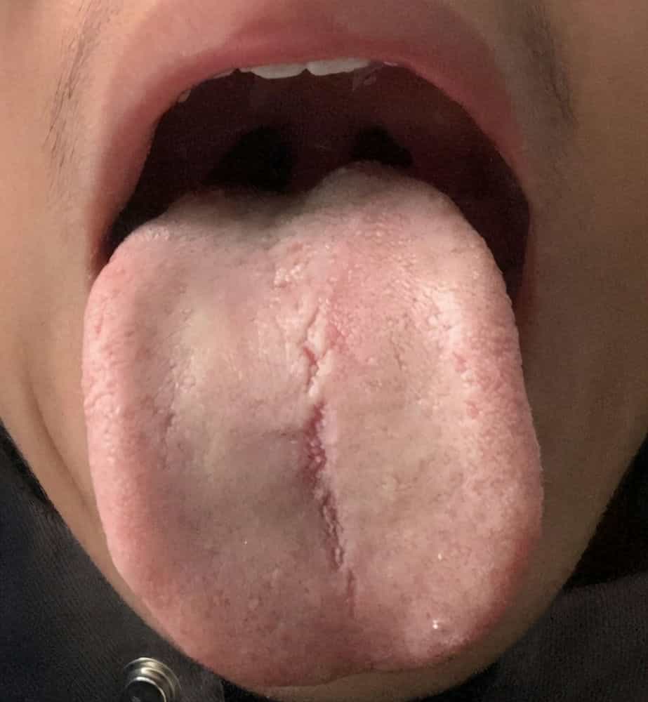 舌头为什么有裂纹舌尖上有八字裂缝是什么原因