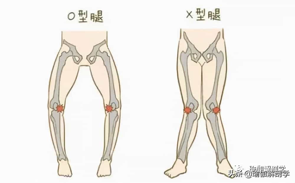 什么是xo型腿什么是xo型腿